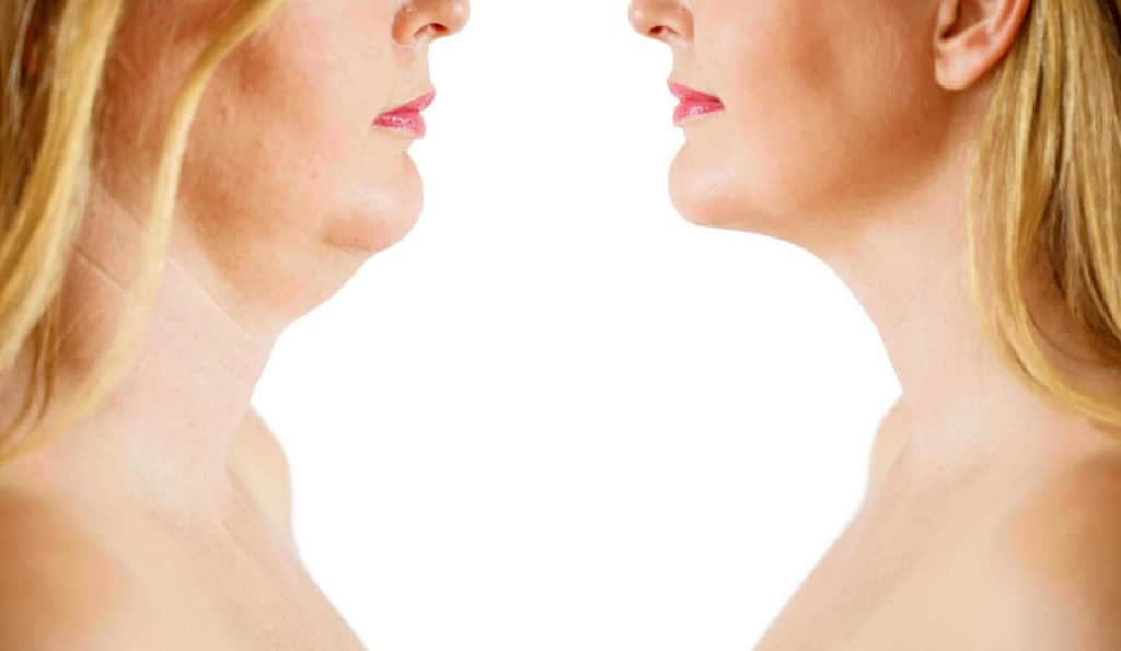 Double Chin treatment Greater London (Barnet) before and after results