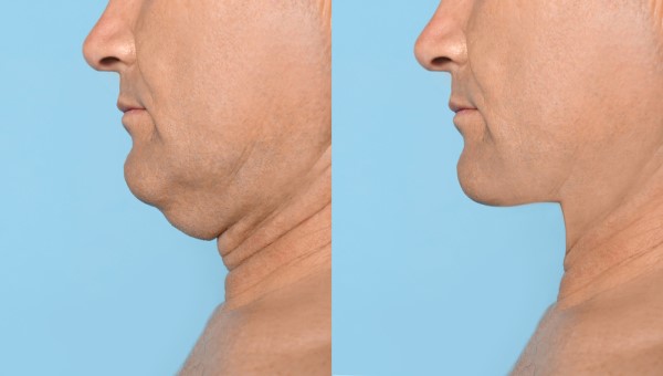 Which Non-Surgical Treatments Work Best for Jowls and Loose Skin Greater London (Barnet)?