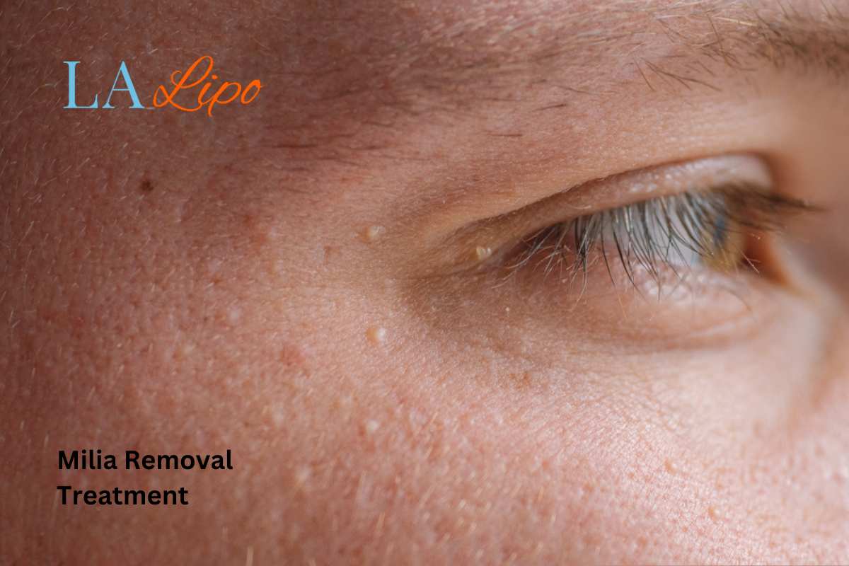 Cryopen Milia Removal: Is It the Easiest and Safest Option Greater London (Barnet)?