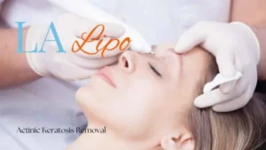 Woman receiving Actinic Keratosis Removal Treatment Greater London (Barnet)
