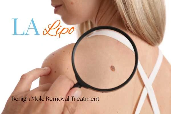 Woman having her inspection of blemish before mole removal Greater London (Barnet)