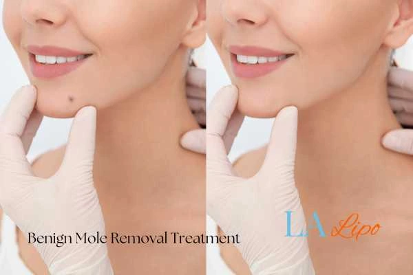 Before and after mole removal Greater London (Barnet) treatment