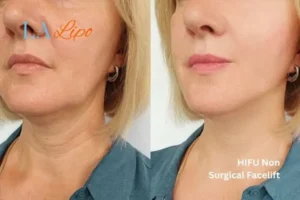 hi-fu for wrinkles Greater London (Barnet) before and after results
