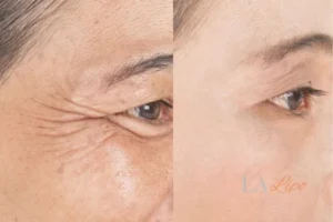 Before and after results of woman - HI-fu wrinkles reduction treatment Greater London (Barnet)