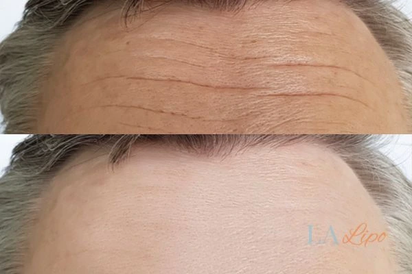 results of HIFU Greater London (Barnet) on mans forehead to help reduce lines and wrinkles