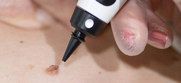 skin tag removal using cryopen Greater London (Barnet)
