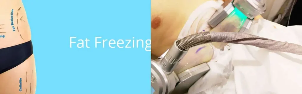 multi areas of a persons body having coolsculpting Greater London (Barnet) treatment