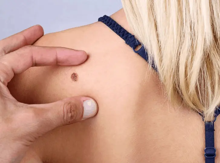 woman having mole removal Greater London (Barnet) consultation before treatment.