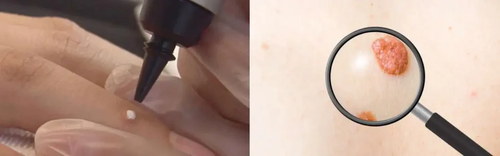 Cryopen for mole removal Greater London (Barnet) - speak to our team today!