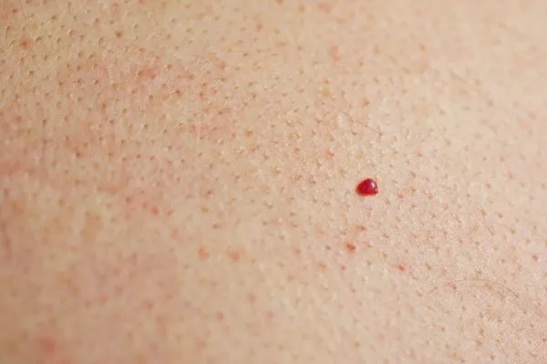 close up of a cherry angioma Greater London (Barnet)