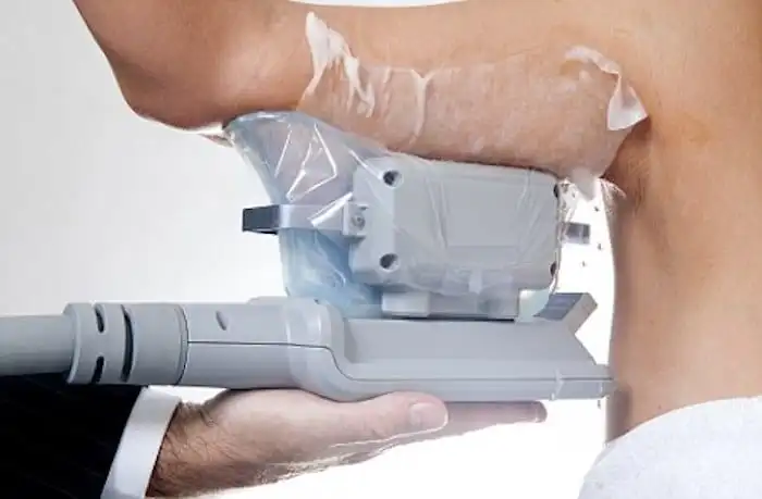 Picture of fat freezing Greater London (Barnet) on the upper arms.
