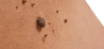 image of a skin tag Greater London (Barnet)