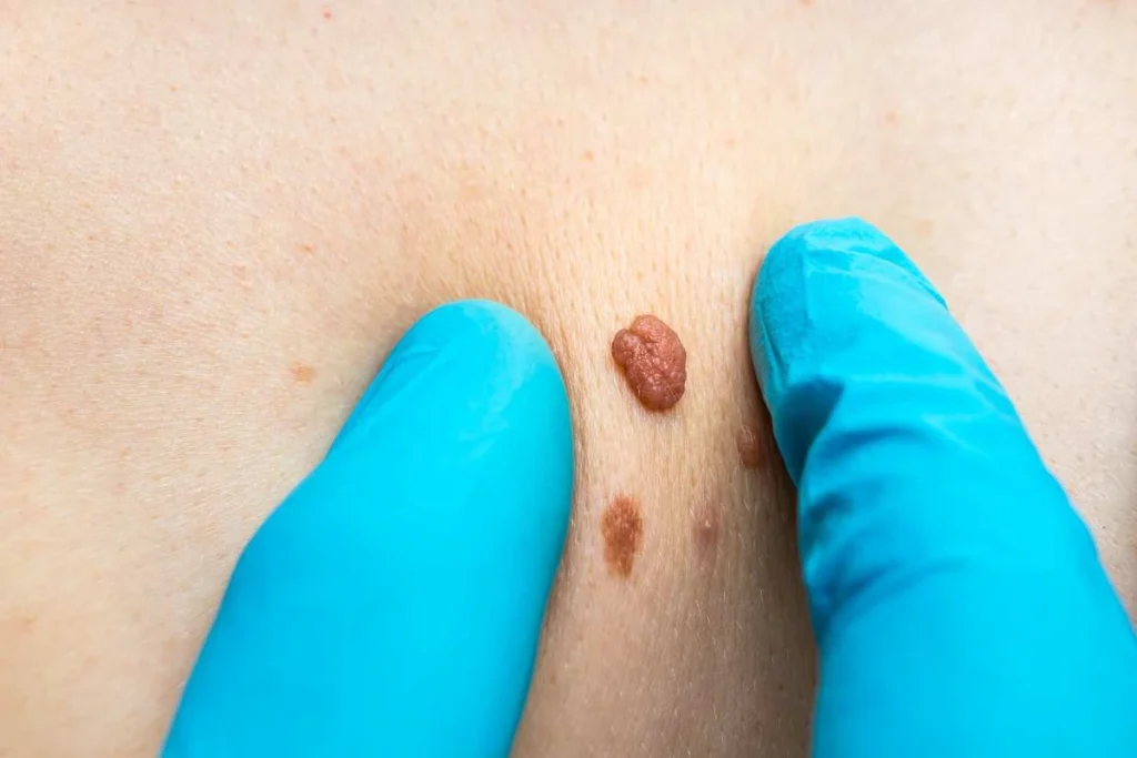Consultant examining a skin tag Greater London (Barnet)