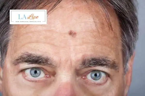 Solar Lentigo Removal Greater London (Barnet) image of man with mark on his forehead