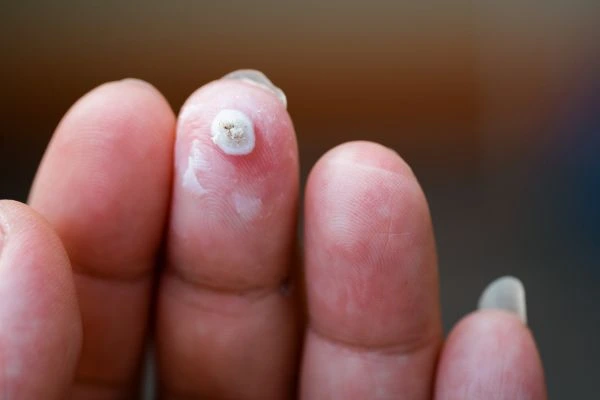 wart on person finger - cryotherapy to treat from LA LIPO Greater London (Barnet)