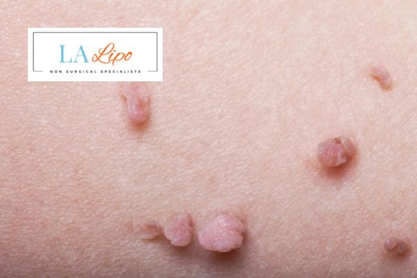 Does cryopen skin tag removal Greater London (Barnet) hurt? Find out now call our team today!