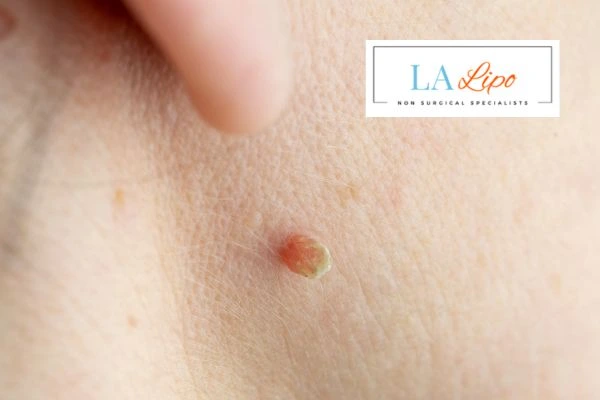 Book skin tag removal Greater London (Barnet) today speak to our team now!