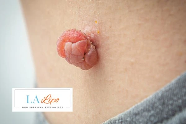 Interested in skin tag removal Greater London (Barnet)? Concerned about the pain? Find out more today!