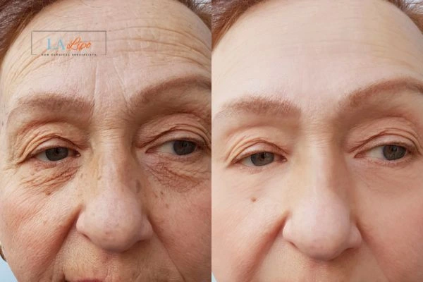 The powerful benefits of Morpheus8 Treatment Greater London (Barnet) - Call Our team today!
