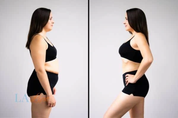 Picture of womans before and after using LA-EMS body sculpting to improve her core strength Greater London (Barnet)