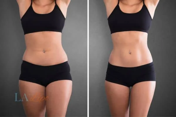 before and after results of non-surgical treatment to help a woman's body image and mental health Greater London (Barnet)