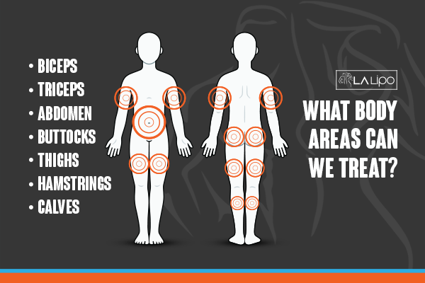 Diagram to show areas you can have LA-EMS Body Sculpting Treatment Greater London (Barnet)