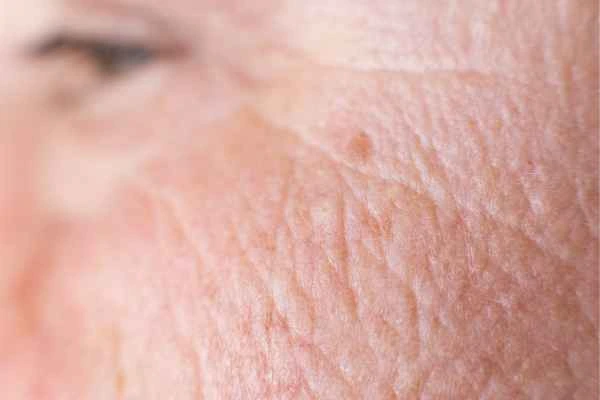 close up picture of a woman's face showing an age spot Greater London (Barnet)
