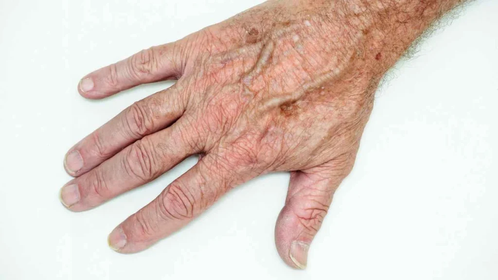 Male hand showing age spot Greater London (Barnet)
