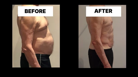 What Symptoms Can Diastasis Recti Cause in Men? Weak Core, Back Pain and Poor Posture Greater London (Barnet)